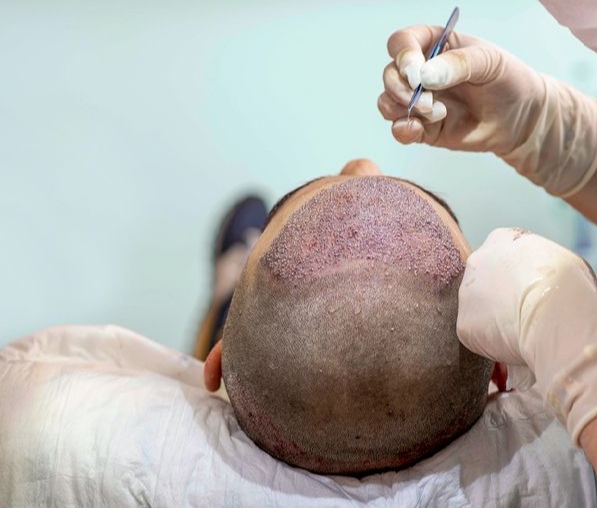 Hair transplant 