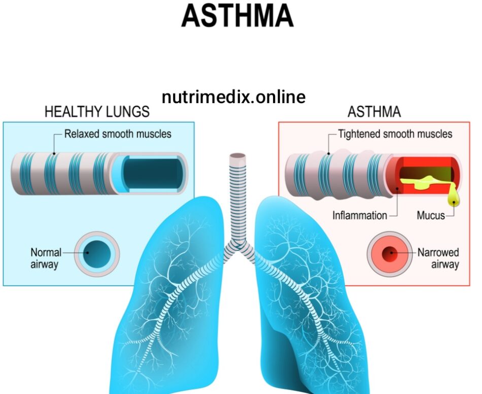 Asthma and Allergies